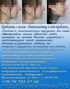 Медицинские услуги в городе Симферополь Rinoplastika_8k.jpg